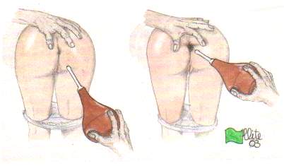 Wsunięcie Końcówki lewatywy